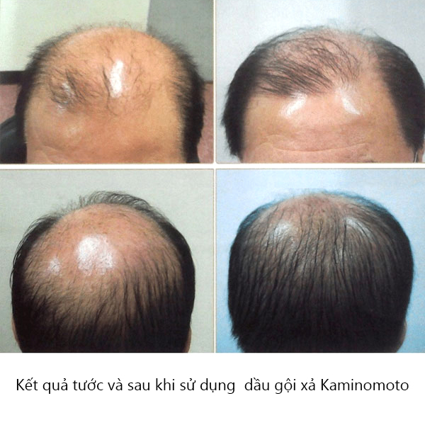 Quá trình mọc tóc khi sử dụng cặp dầu gội xả Kaminomoto đều đặn trong vài tháng