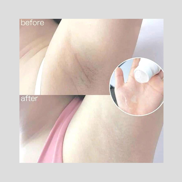 Kết quả trước và sau khi sử dụng lăn nách Kwangdong