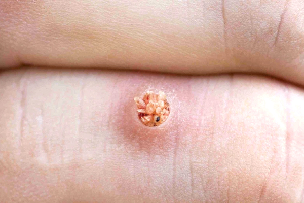 Mụn cóc gây ra bởi virus HPV