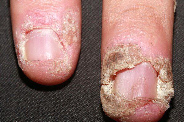 Mụn cóc gây nên các khối u nhỏ trên da khiến mất thẩm mỹ trầm trọng