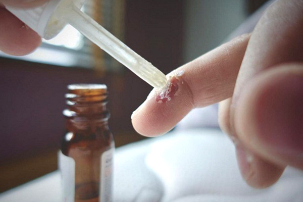 Sử dụng thuốc trị mụn cóc tại nhà là phương pháp được nhiều người lựa chọn