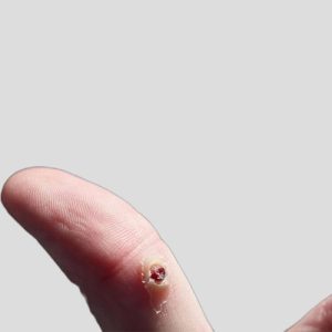Mua thuốc trị mụn cóc