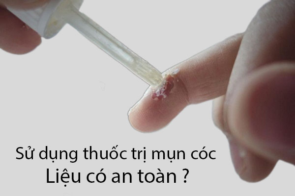 Thuốc trị mụn cóc có an toàn không là câu hỏi nhận được nhiều sự quan tâm
