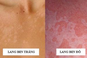 Bệnh lang ben là gì?
